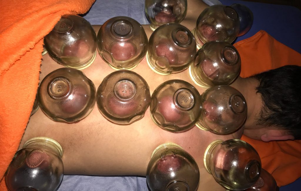 Cupping